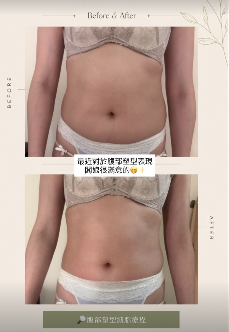美體案例 05・腹部護理，原圖上方為護理前，下方為護理後