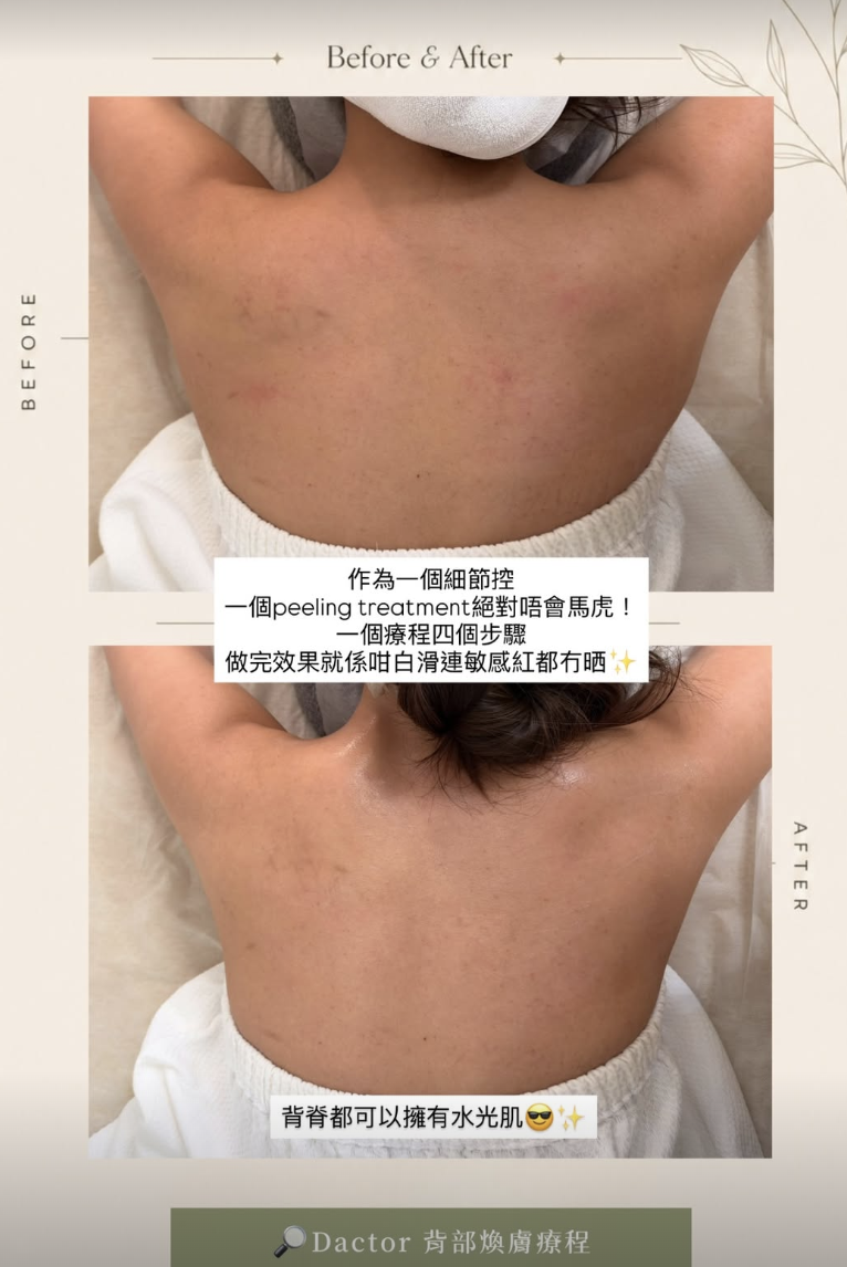 Dactor Peel 背部煥膚案例，原圖上方為護理前，下方為護理後